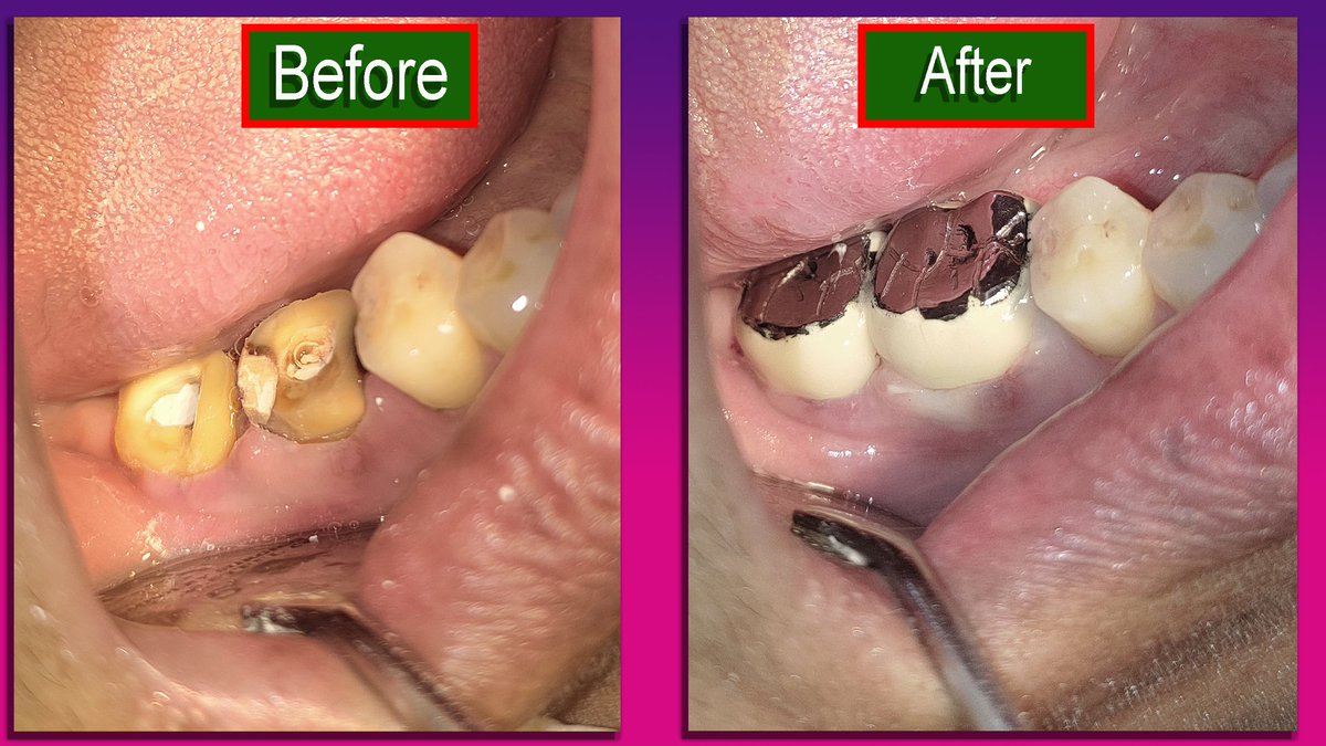 Dental cap
#toothcap #dentalcap #dentalcrown #toothcrown #porcelaincrown