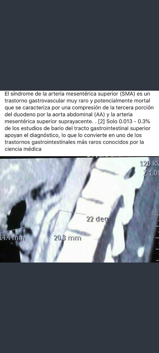 Itsalbiuus_'s tweet photo. Por fin puedo decir orgullosa que he sido más fuerte que el Síndrome de Wilkie, muchos de los afectados hoy ya no tienen voz, la enfermedad decidió arrebatarsela. 

Ahora toca seguir recuperándose, y esperemos que sin recaídas.🖤 https://t.co/KYNamy9ZiQ
