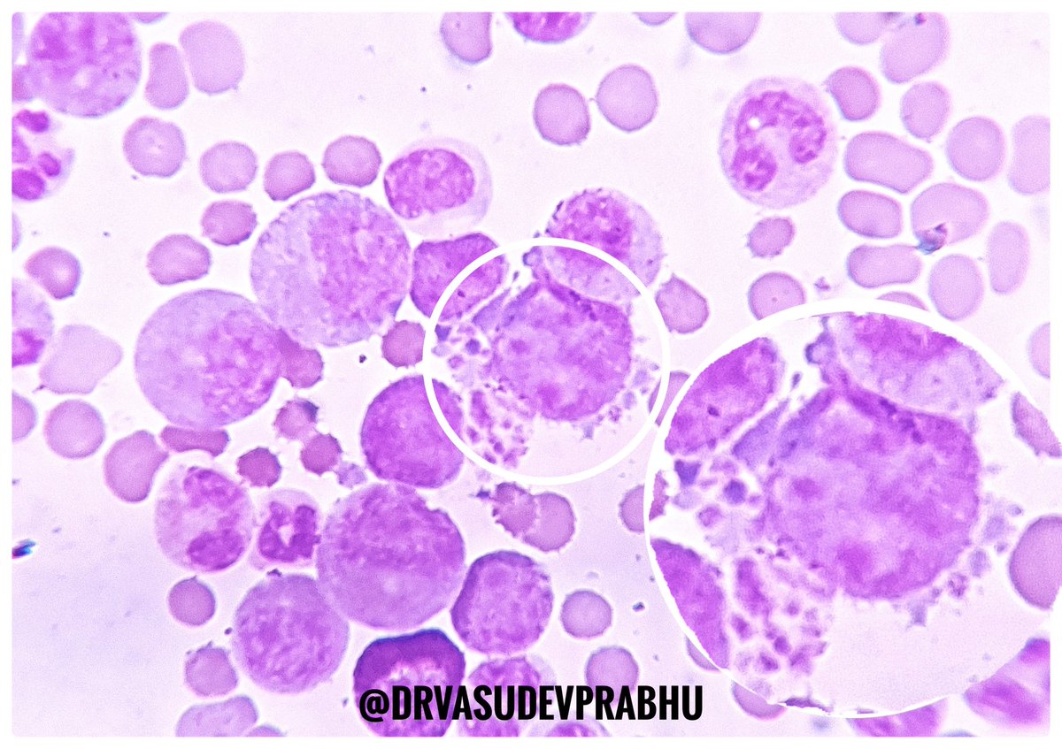DrVasudevPrabhu's tweet photo. Just a Budding megakaryocyte releasing new platelets to share ๏ฟฝ๏ฟฝ
#hematology #hematologyimagebank @PathSpotters #basichematology #PathTwitter @anjuthevirgo @DrApoorvaN1 @archibhat3 @tumashankar @RizviUroos https://t.co/mx3bRZSgR5