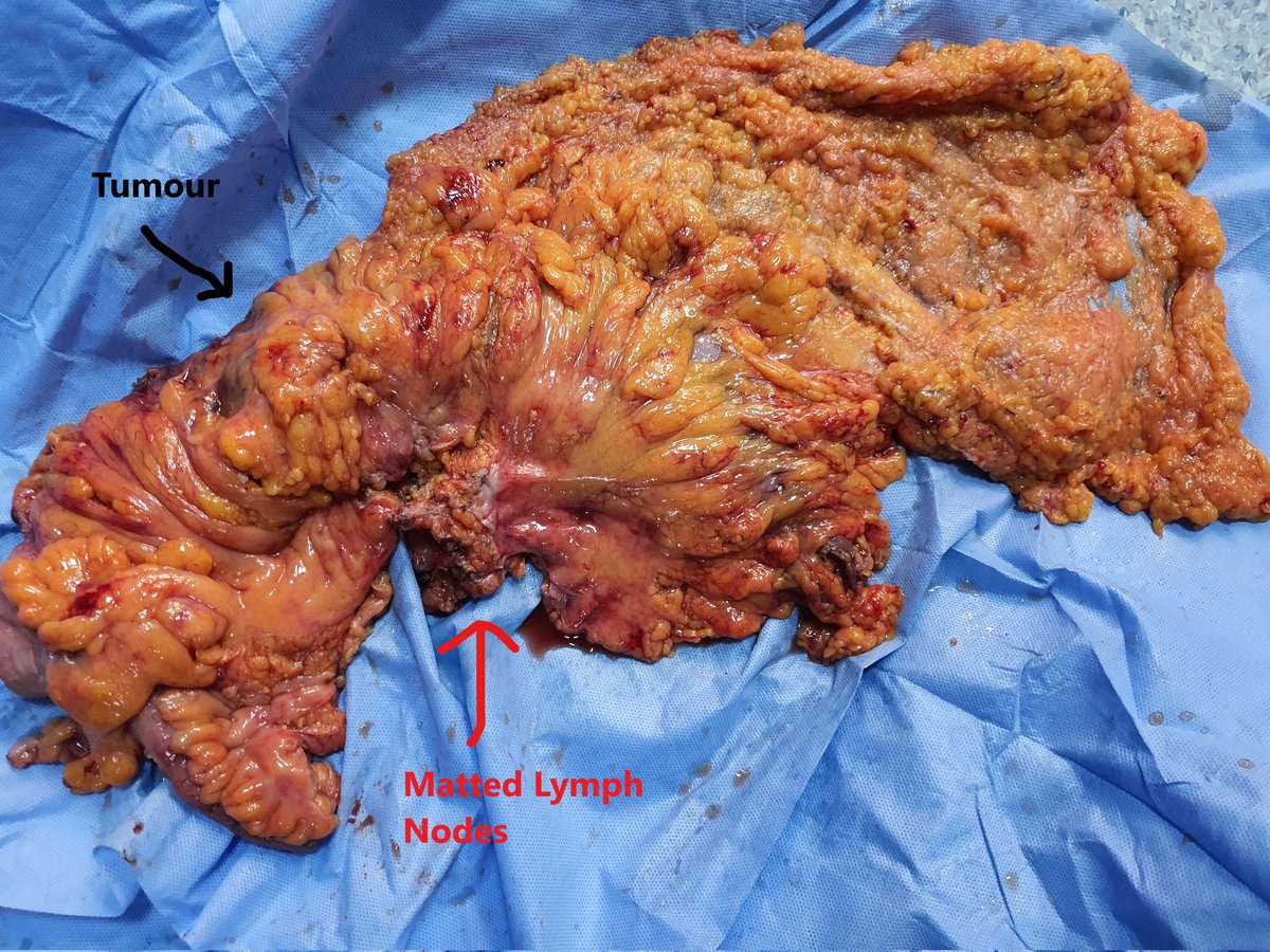 uraiqat's tweet photo. 59 Yr male. Hep flxr tumor with enlarged matted 214, 216, 223 LNs. Had extended right hemicolectomy with CME and LN excision.@DaniaNsour @OmarFaiz_SETOC @ScottRSteeleMD  @AISChannel @kmadbouly @k_mestareehy @almaaita_dr https://t.co/06WZWAzW8E