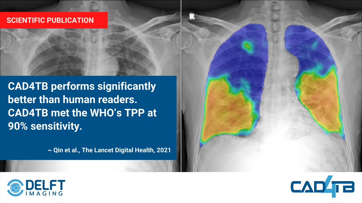DelftImaging's tweet photo. In the study by @TheLancet, it was found that #CAD4TB performs significantly better than human readers. CAD4TB met the WHOโs Target Product Profile (TPP) at 90% sensitivity.
Read publication: https://t.co/86OoaL8F3W
#delftimaging #healthcare #digitalhealth #healthcareit #AI https://t.co/CBwLDERG8l