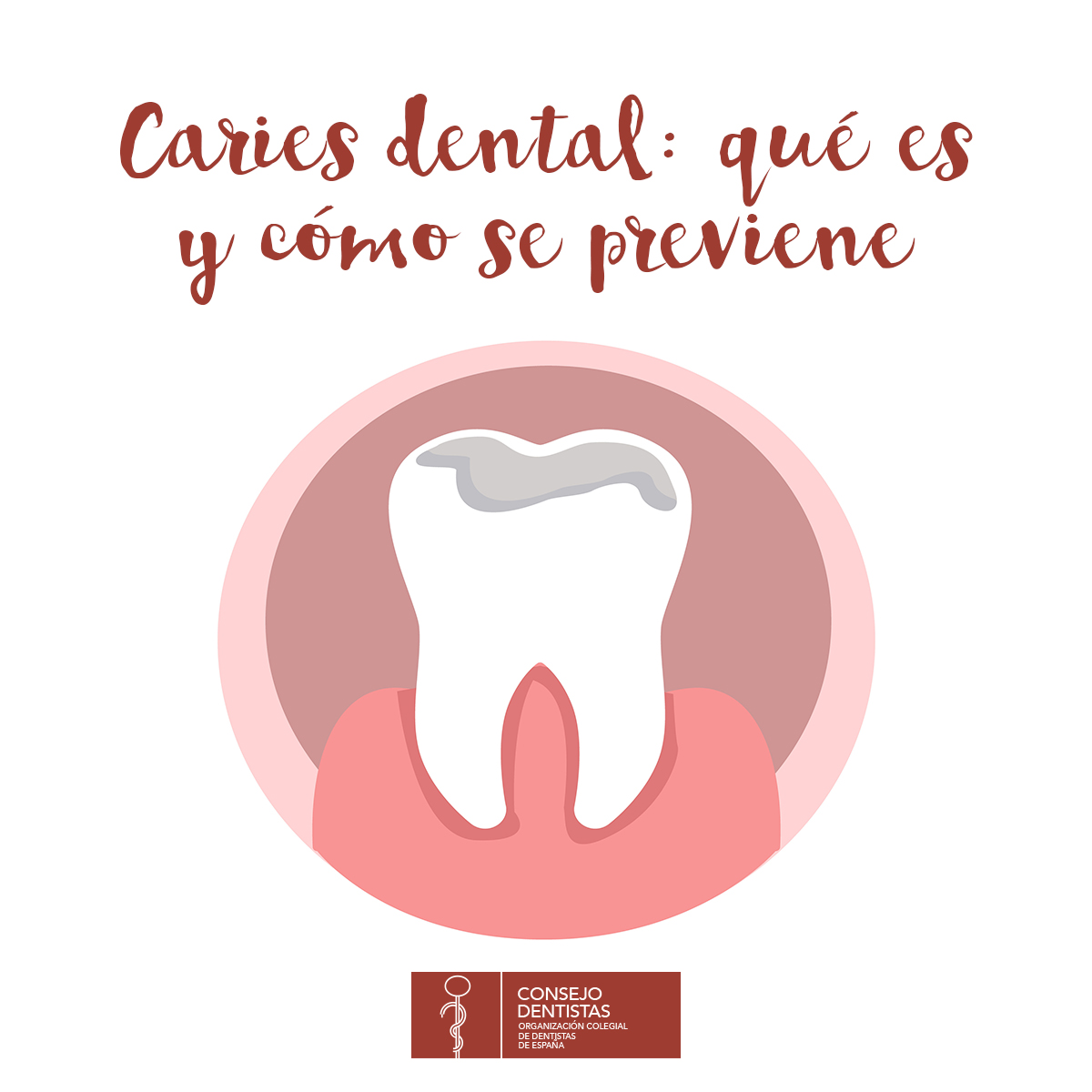 CNSJ_Dentistas's tweet photo. La caries es una patología oral caracterizada por la presencia de microorganismos cariogénicos en la superficie dental, que metabolizan los azúcares y los convierten en ácidos que debilitan las piezas dentales. https://t.co/VoOBMv9f6W