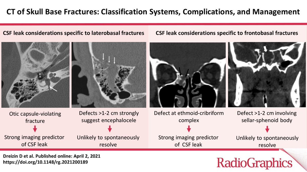 Maryland Neurosurgery (@umdneurosurgery) on Twitter photo An exhaustive, valuable review in <a href="/RadioGraphics/">RadioGraphics</a> of CT findings in skull base fractures and clinical management by our team, colleagues in <a href="/mdneurorads/">UMaryland Neuroradiology</a> <a href="/shocktrauma/">Shock Trauma</a> UMD ENT, and UMD OMFS. Read: bit.ly/3ENlhW5 <a href="/AANSCNStrauma/">Neurotrauma Section</a> An exhaustive, valuable review in <a href="/RadioGraphics/">RadioGraphics</a> of CT findings in skull base fractures and clinical management by our team, colleagues in <a href="/mdneurorads/">UMaryland Neuroradiology</a> <a href="/shocktrauma/">Shock Trauma</a> UMD ENT, and UMD OMFS. Read: bit.ly/3ENlhW5 <a href="/AANSCNStrauma/">Neurotrauma Section</a>