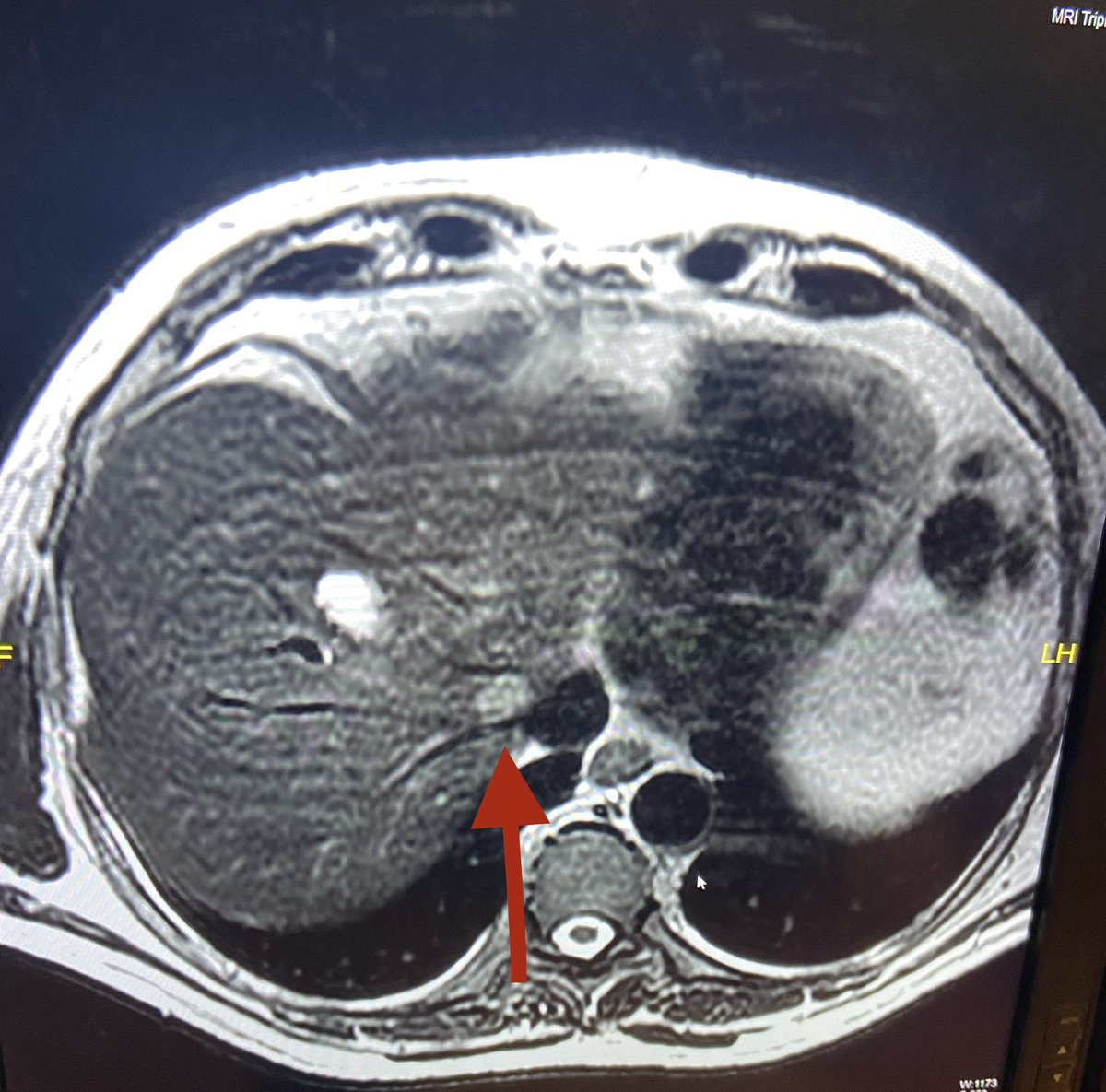 Manish Jain (@manishdoc2000) on Twitter photo Ca sigmoid one year follow up with solitary liver metastasis at difficult location. Other lesions are hemangiomas.
Options for local treatment
RFA
Microwave
Surgery
SBRT
<a href="/GlobalHepato/">Global Hepato-Pancreato-Biliary Collaboration</a> <a href="/TorzilliGuido/">GUIDO TORZILLI</a> <a href="/hpb_so/">SoMe4HPB</a> <a href="/SirohiBhawna/">bhawna sirohi</a> <a href="/AmericanCancer/">American Cancer Society</a> <a href="/harit_oncochat/">Harit Chaturvedi</a> <a href="/senthilnathan94/">P.Senthilnathan</a> <a href="/IHPBA/">IHPBA</a> Ca sigmoid one year follow up with solitary liver metastasis at difficult location. Other lesions are hemangiomas.
Options for local treatment
RFA
Microwave
Surgery
SBRT
<a href="/GlobalHepato/">Global Hepato-Pancreato-Biliary Collaboration</a> <a href="/TorzilliGuido/">GUIDO TORZILLI</a> <a href="/hpb_so/">SoMe4HPB</a> <a href="/SirohiBhawna/">bhawna sirohi</a> <a href="/AmericanCancer/">American Cancer Society</a> <a href="/harit_oncochat/">Harit Chaturvedi</a> <a href="/senthilnathan94/">P.Senthilnathan</a> <a href="/IHPBA/">IHPBA</a>