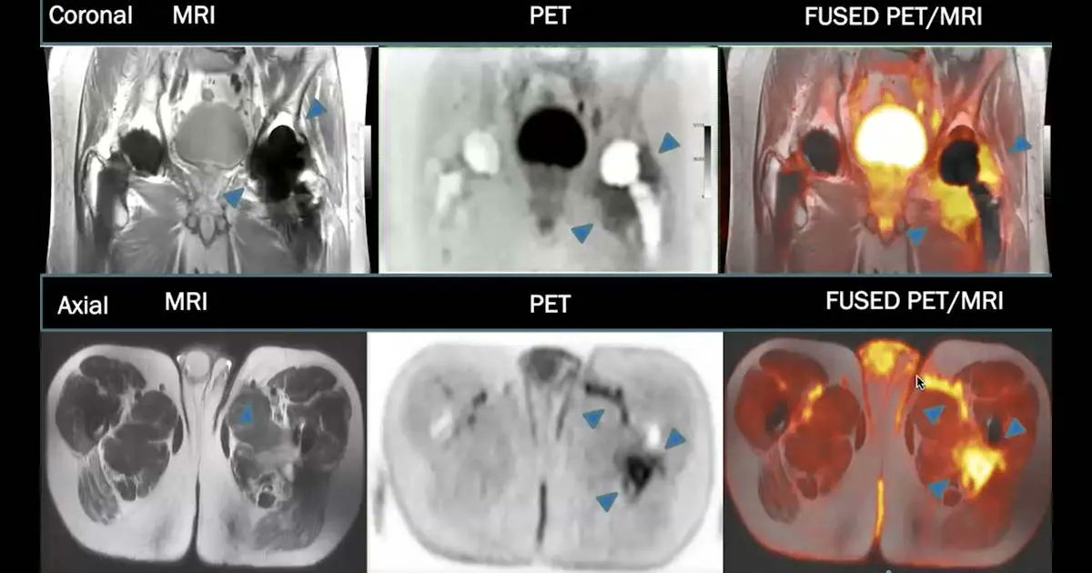AuntMinnie's tweet image. PET diagnoses prosthetic joint infection at #RSNA21 #radiology  bit.ly/3lG2aFy