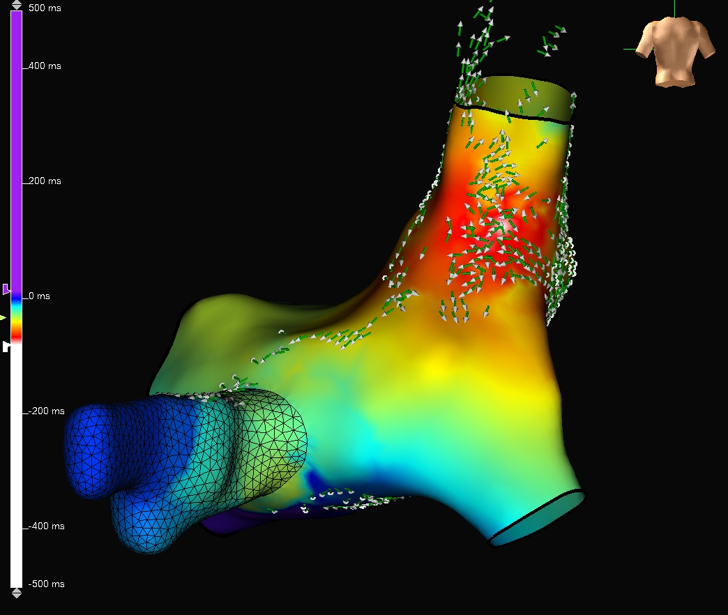 Steven Coutteau (@stevenc_ep) on Twitter photo Excited to showcase the new power of #EnSiteX! Was able to pinpoint this focal AT in the septal posterior RA to the millimeter using OT. I LOVE the increased specificity due to #TrueEGMs and point resolution - and activation vectors!! <a href="/AbbottCardio/">Abbott Cardiovascular</a> #HDGrid #OnlyWithOT #EPeeps Excited to showcase the new power of #EnSiteX! Was able to pinpoint this focal AT in the septal posterior RA to the millimeter using OT. I LOVE the increased specificity due to #TrueEGMs and point resolution - and activation vectors!! <a href="/AbbottCardio/">Abbott Cardiovascular</a> #HDGrid #OnlyWithOT #EPeeps