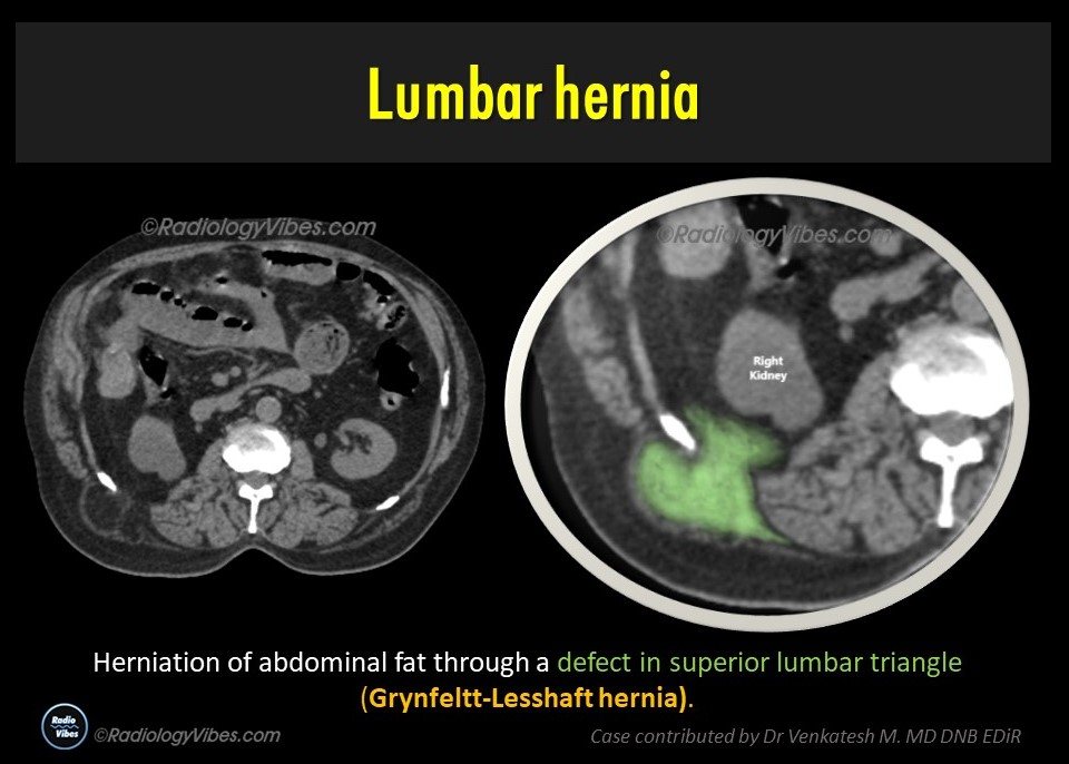 Lumbar Hernia