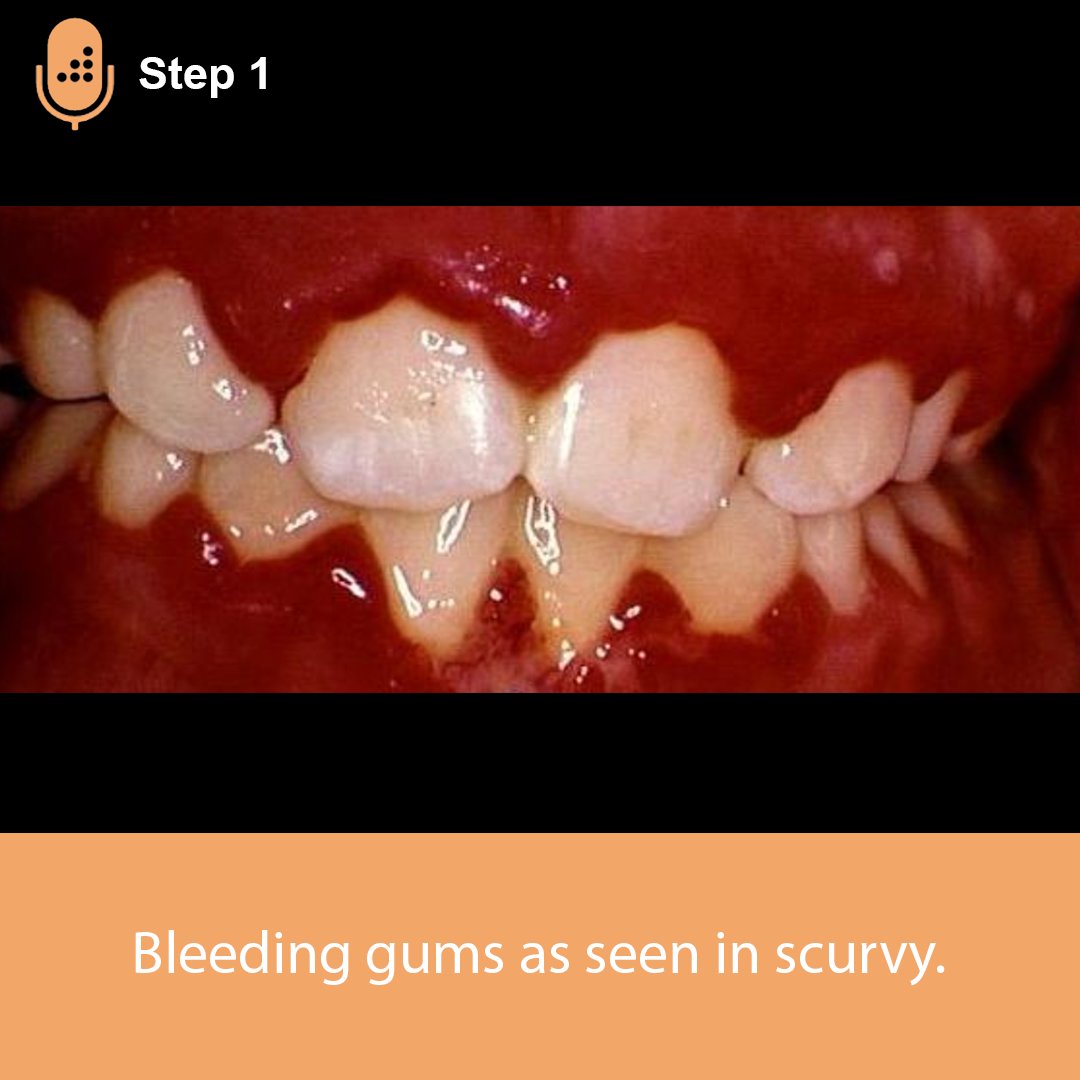 Pediatric Radiology Scurvy Vitamin C Deficiency Imagi vrogue.co