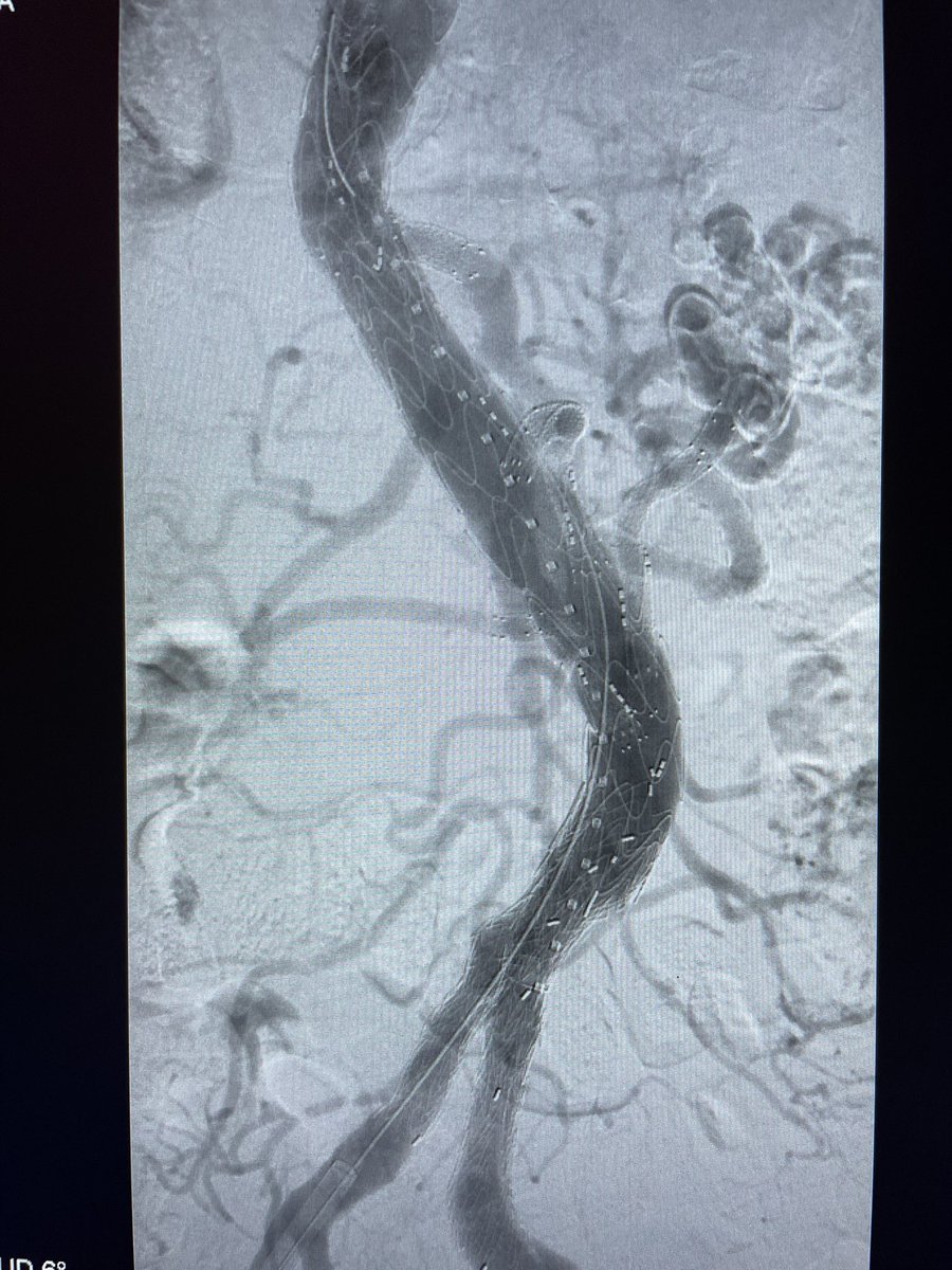 DanielMilesMD (@danielmilesmd) on Twitter photo Impending rupture sp fenestrated repair (pain, rapid sac growth) from 1b and psb 1c endoleak. Tx with CA/SMA branch extension/angioplasty and iliac branch device (2/2 size). <a href="/VascularSurgCS/">Cedars-Sinai Division of Vascular Surgery</a> <a href="/VSA_LLC/">Vascular Surgery Associates</a> <a href="/MoridzadehMD/">Rameen S. Moridzadeh, MD</a> <a href="/DeptSurgeryCS/">Department of Surgery at Cedars-Sinai</a> #aortaed #VascSurg #vasculartwitter Impending rupture sp fenestrated repair (pain, rapid sac growth) from 1b and psb 1c endoleak. Tx with CA/SMA branch extension/angioplasty and iliac branch device (2/2 size). <a href="/VascularSurgCS/">Cedars-Sinai Division of Vascular Surgery</a> <a href="/VSA_LLC/">Vascular Surgery Associates</a> <a href="/MoridzadehMD/">Rameen S. Moridzadeh, MD</a> <a href="/DeptSurgeryCS/">Department of Surgery at Cedars-Sinai</a> #aortaed #VascSurg #vasculartwitter