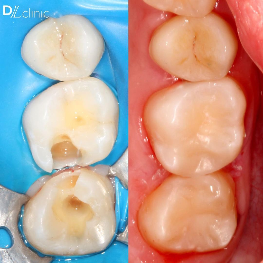 Лечение скрытого #кариеса: 

✅ изоляция зубов коффердамом 
✅ раскрытие кариозной полости
✅ очистка кариозной полости под микроскопом
✅ установка матриц для восстановления контактных поверхностей 
✅ реставрация композитным материалом
✅ шлифовка и полировка реставрации.