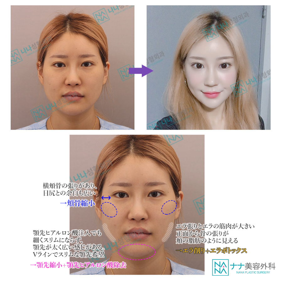 韓国nana美容外科 Nana輪郭3点 正面症例 頬骨とエラの張り で顔が広がって見える輪郭 特に顔の余白が多いと顔が大きく見えるため横頬骨は削り前頬にボリュームを入れ エラ削りで角張った顎ラインを整えます また筋肉が大きい場合はボトックス追加も可能