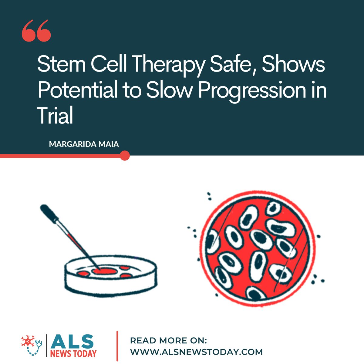 alsnewstoday's tweet photo. • Hot off the press, read the latest article on our #ALSNewsToday website! •
A small trial found repeat injections of mesenchymal #stemcells safe, with a potential to significantly slow the rate of #ALS progression. Read more: https://t.co/pZWpnUdnSe
#ALSresearch #treatingALS https://t.co/1AWbwQgjGU