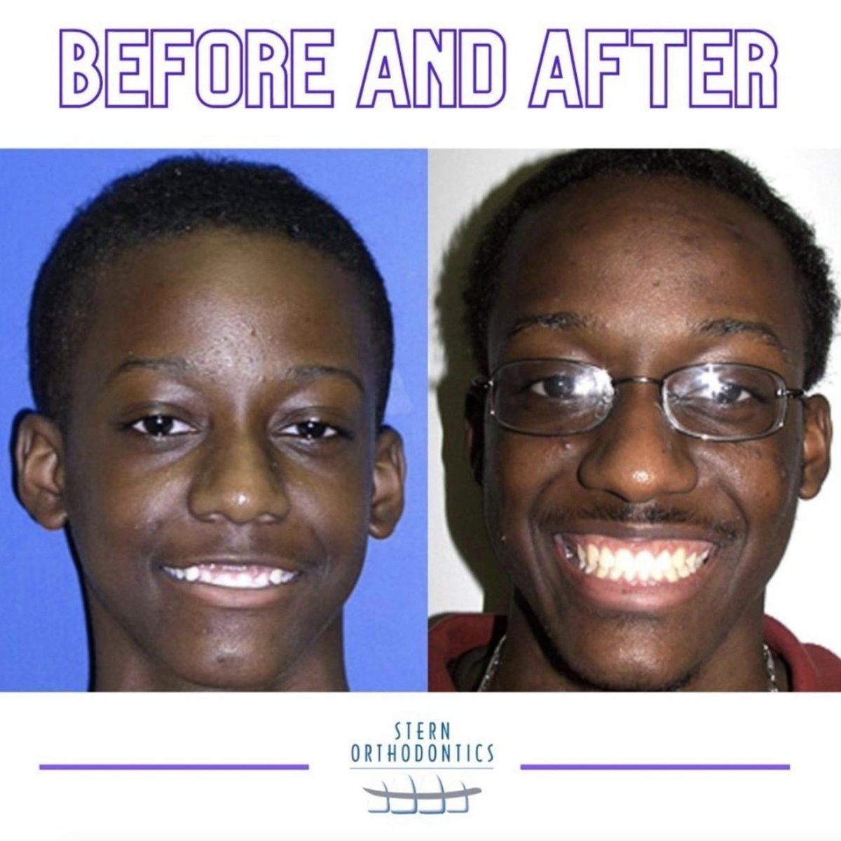 SternOrtho's tweet photo. Transformation Tuesday 😁!

Schedule a FREE consultation to start yours today!

Cherry Hill 856-424-4100
Vineland 856-691-7142
Bridgeton 856-451-6328
Pennsville 856-678-5800

https://t.co/bom4hs0ji5

#SternOrtho #orthodontist #orthodontics #invisalign #braces #teeth #smile #love https://t.co/xNJTMNxYIR