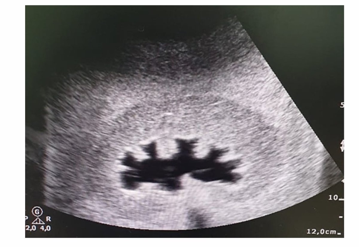 Fabio Vicentini 🇧🇷 (@vicentiniuro) on Twitter photo <a href="/LukeUrology/">Luke Gordon</a> <a href="/BSoT_UK/">BSoT</a> This model is very useful. If you have the opportunity, try the kidney phantom from <a href="/gphantomBR/">Gphantom - Simuladores para Treinamento Médico</a> also. The best that I've ever used. en.gphantom.com.br/product-page/g… COI: developer <a href="/LukeUrology/">Luke Gordon</a> <a href="/BSoT_UK/">BSoT</a> This model is very useful. If you have the opportunity, try the kidney phantom from <a href="/gphantomBR/">Gphantom - Simuladores para Treinamento Médico</a> also. The best that I've ever used. en.gphantom.com.br/product-page/g… COI: developer