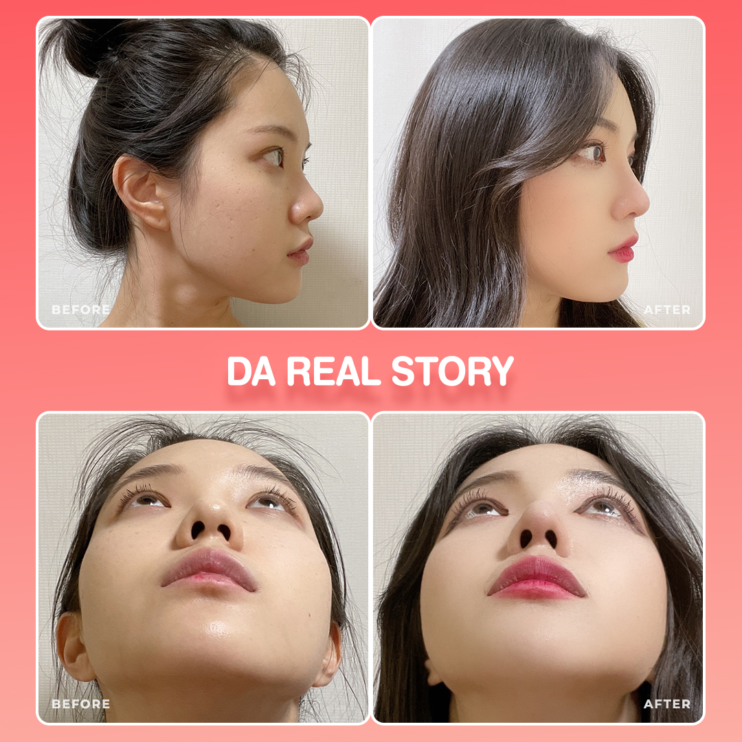 Plastic Surgery Before And After Nose Korean