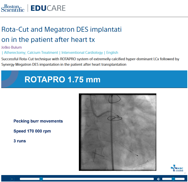 BSC_EU_Heart's tweet image. Check out this Rota-Cut technique with #ROTAPRO system of extremely calcified hyper-dominant LCx followed by Synergy Megatron DES implantation after heart transplantation, by Prof. Joško Bulum, University Hospital Centre Zagreb, Croatia. More on EDUCARE : educare.bostonscientific.eu/s/educare-view…