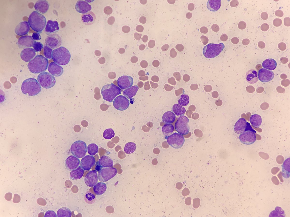 PaddyTassin's tweet photo. First patient of the day…#hemepath #cytology #hematology https://t.co/yoAe3DQtX8