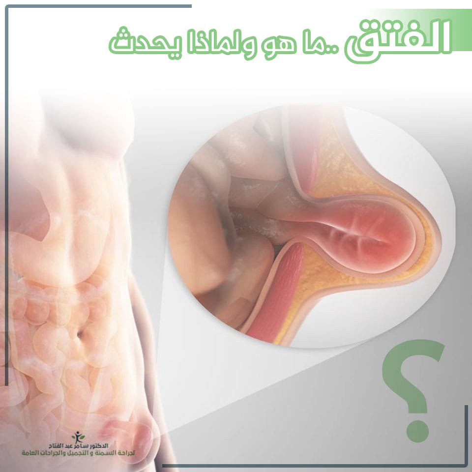 #الفتق هو عبارة عن خروج عضو أو جزء من مكان المخصص له من خلال جدار التجويف الذي يحتويه، يحدث الفتق أو التمزق عندما يندفع الجزء الداخلي من الجسم من خلال وجود ضعف في العضلات المحيطة أو أنسجة جدار

#الدكتور_سامر_عبدالفتاح