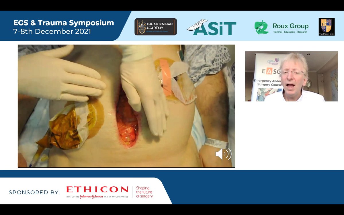 The Dukes' Club (@dukes_club) on Twitter photo Prof Sugrue providing a masterclass in understanding how to manage patients with an open abdomen and abdominal compartment syndrome #egstraumameeting <a href="/ASiTofficial/">ASiT</a> <a href="/ASGBI_MA/">ASGBI Moynihan Academy</a> <a href="/roux_group/">The Roux Group</a> @Ethicon Prof Sugrue providing a masterclass in understanding how to manage patients with an open abdomen and abdominal compartment syndrome #egstraumameeting <a href="/ASiTofficial/">ASiT</a> <a href="/ASGBI_MA/">ASGBI Moynihan Academy</a> <a href="/roux_group/">The Roux Group</a> @Ethicon
