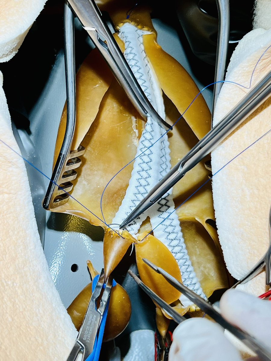 Mital Desai (@myxworld) on Twitter photo Trainees working hard <a href="/NHSHEE_LDN/">NHSE Workforce, Training and Education - LDN</a> <a href="/ImperialVasc/">Imperial College London Vascular Surgery</a> teaching sessionā¦simulator training at its best! Trainees working hard <a href="/NHSHEE_LDN/">NHSE Workforce, Training and Education - LDN</a> <a href="/ImperialVasc/">Imperial College London Vascular Surgery</a> teaching sessionā¦simulator training at its best!