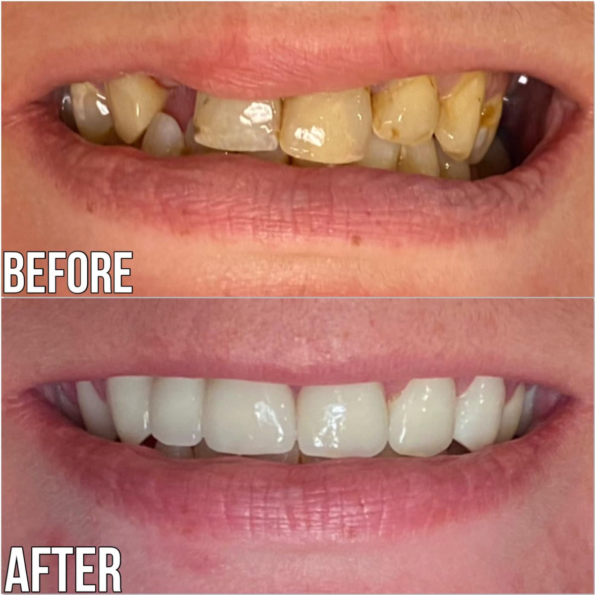 Full Upper Arch Rehab 
Dr. Bobby F. Shunnarah completed a full upper arch rehab which included 4 anterior (front) top EMAX porcelain crowns and posterior (back) porcelain bridges on both sides. 
The patient is so happy with her new smile and so are we!
