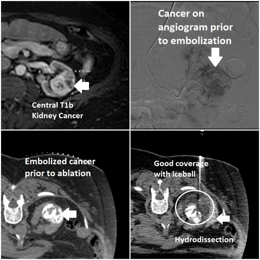 Large (T1b) kidney #cancer in a patient with chronic #kidney disease treated by interventional radiology (#IRad) using a combination of trans-radial embolization with alcohol &amp; lipodol and image-guided cryoablation performed on the same day as an outpatient procedure.