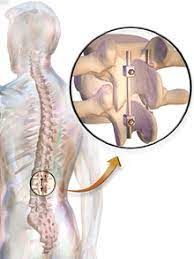 and_advances's tweet image. #Spinal_fusion is also called as spondylosis is a neurosurgical or orthopedic surgical technique that joins two or more vertebrae. This procedure can be performed at any level in the spine (cervical or lumbar) and prevents any movement between the fused vertebrae. #macr