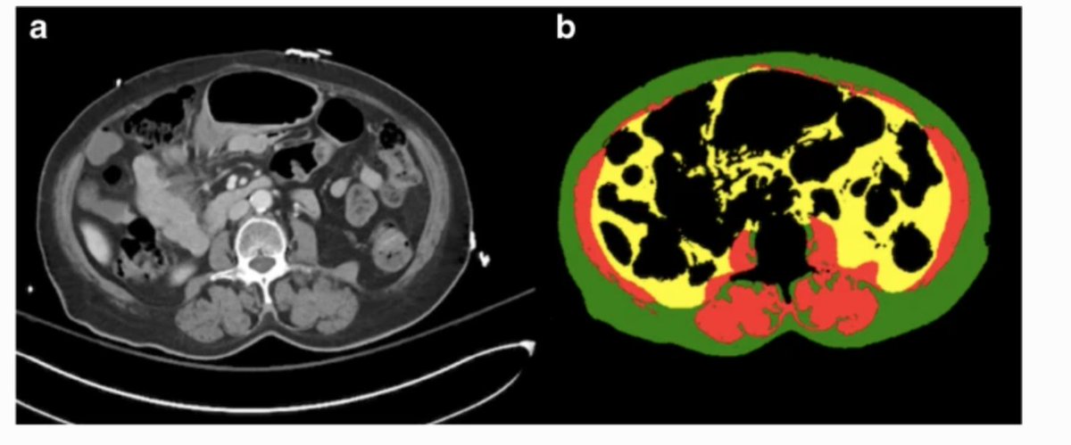 OlgaLaurMD's tweet photo. Excited to share our new work on "CT-based body composition profile as a screening tool for geriatric frailty detection" published in @SkeletalRadiol. Many thanks to @KhuranaBharti @MHRBoston for their help and support in this🙏👍👐

https://t.co/kpWg08D7XR https://t.co/B4luOiyzn9