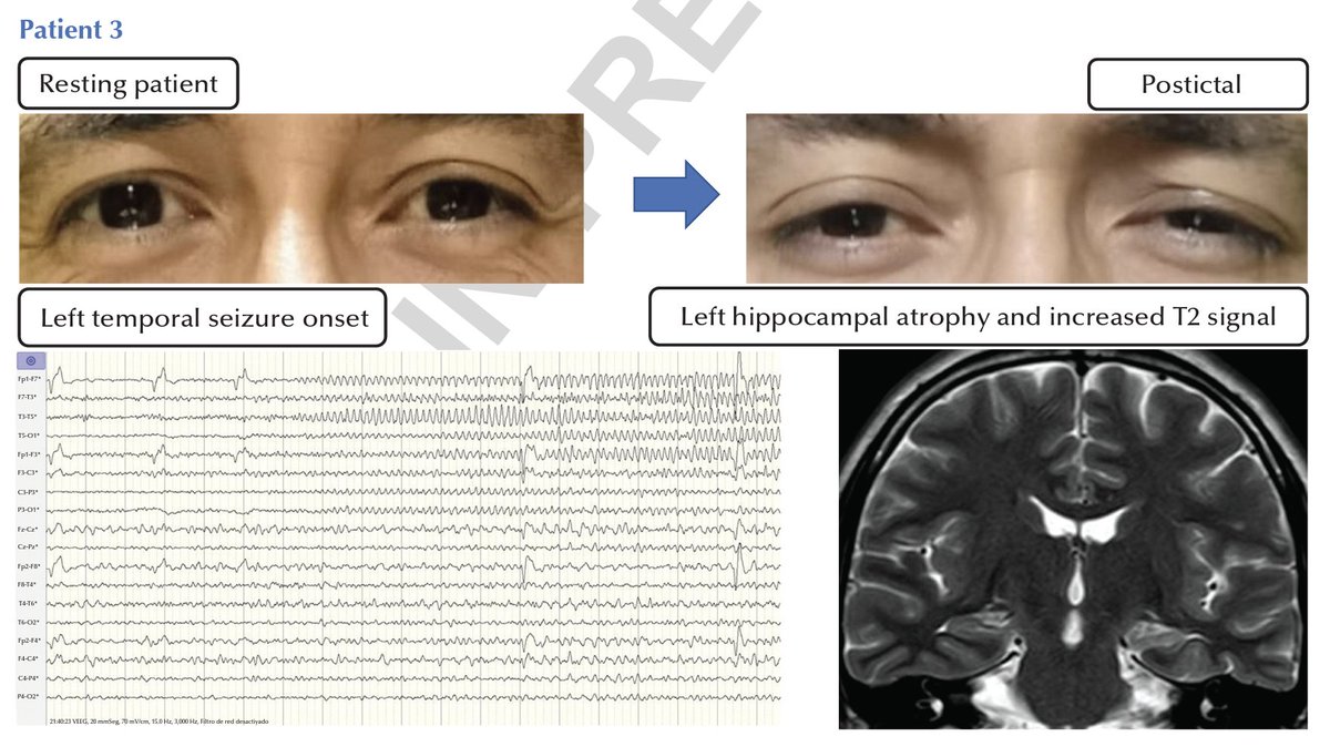 Fábio Nascimento (@fabnascimen) on Twitter photo Carrillo et al. reported postictal subtle ptosis ipsilateral to mesial temporal lobe sclerosis in 3 patients👇. This phenomenon may be explained by central autonomic dysfunction. <a href="/SBeniczky/">Sandor Beniczky</a> <a href="/EpiDisorders/">Epileptic Disorders</a> <a href="/yesILAE/">yesILAE</a> 
jle.com/en/revues/epd/… Carrillo et al. reported postictal subtle ptosis ipsilateral to mesial temporal lobe sclerosis in 3 patients👇. This phenomenon may be explained by central autonomic dysfunction. <a href="/SBeniczky/">Sandor Beniczky</a> <a href="/EpiDisorders/">Epileptic Disorders</a> <a href="/yesILAE/">yesILAE</a> 
jle.com/en/revues/epd/…