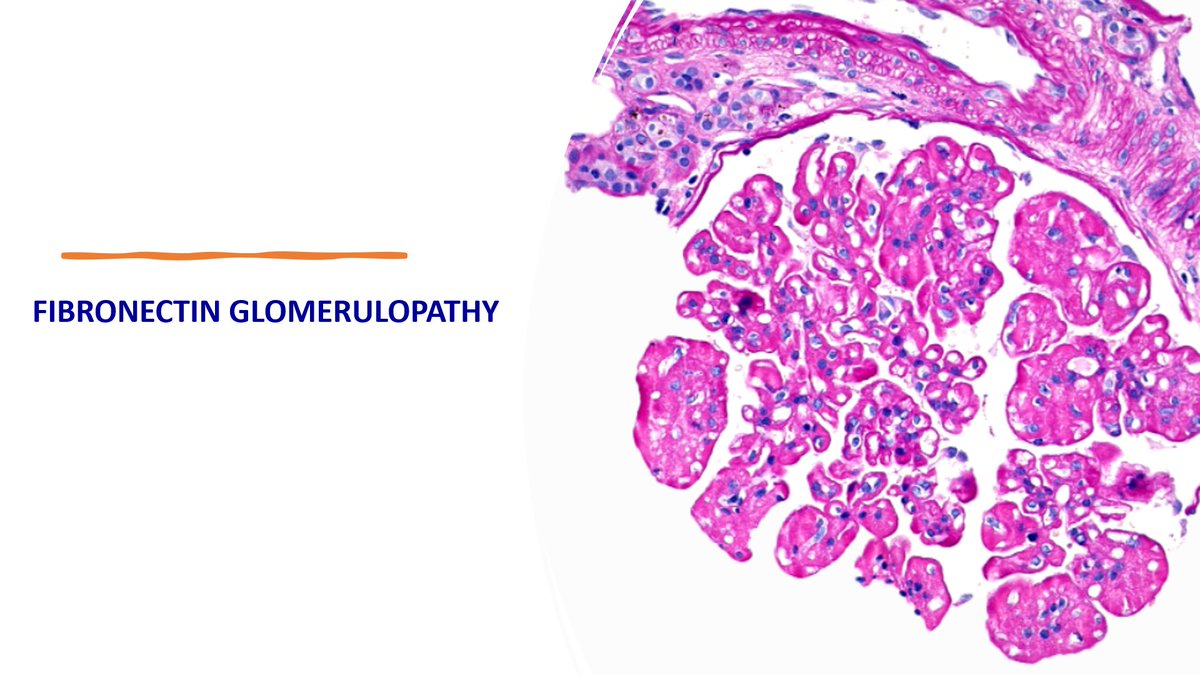 ArchanaVajjala's tweet photo. 1/📢Hello #medtwitter
This November's @ASPNeph Renal Pathology webinar was on ⚡️Fibronectin glomerulopathy (FNG)⚡️ Here are some interesting points I learned!
#medtweetorial #NephTwitter #ASPNeph #pedneph #Renalpath #Nephpath https://t.co/fsePXZKCI3