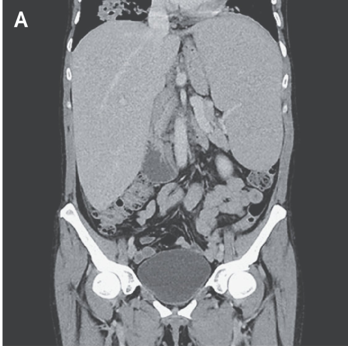 S__Baksh's tweet photo. Me, a med student: no hepatosplenomegaly appreciated on exam https://t.co/N7QvgxywZn