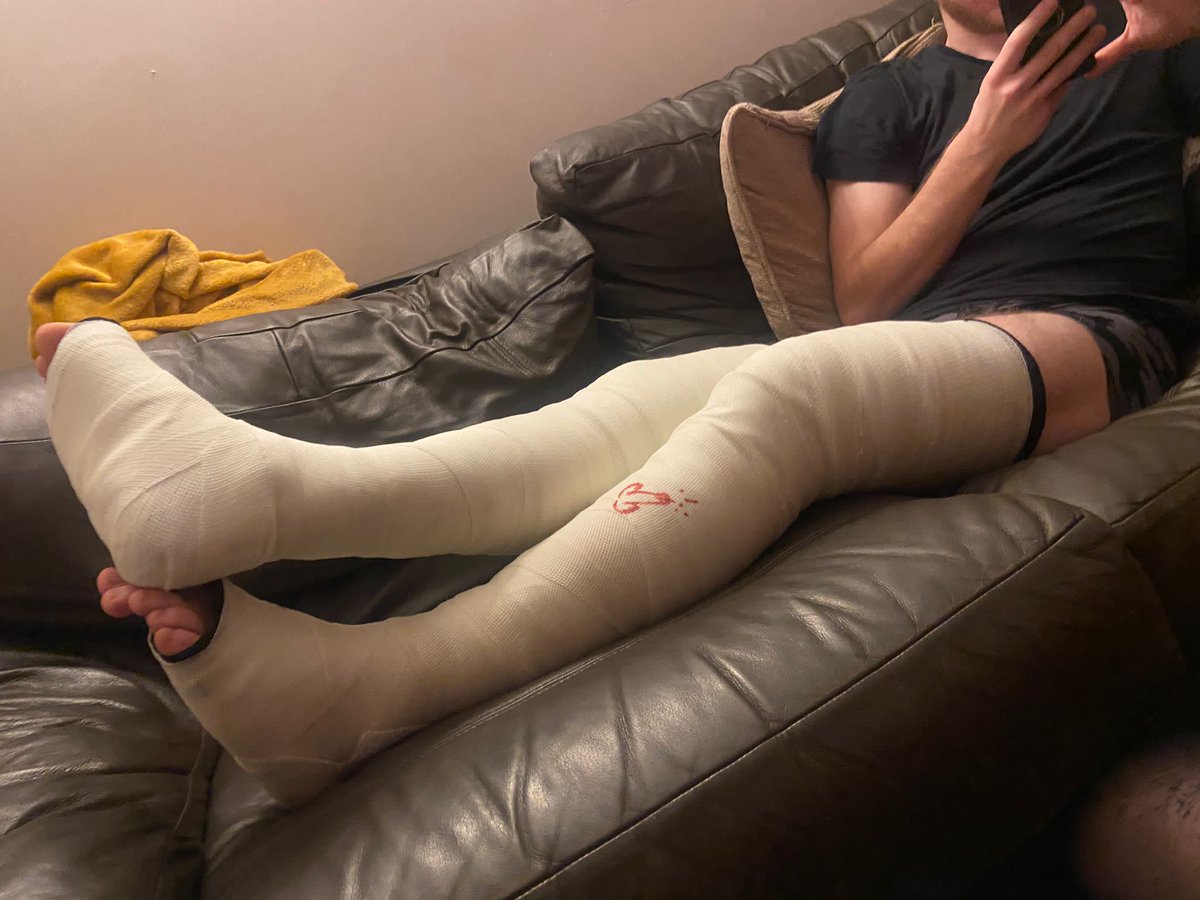 Purplejonesy's tweet photo. When @mystrix10 says she wants to practice doing casting, of course I gladly volunteer a leg. Wasn't happy with the first one so asked to try again...who am I to say no ๐คทโโ๏ธ.
#llc #legcast #longlegcast #fibre #fibrecast #cast #fulllegcast #getcasted #castfetish #castbondage https://t.co/ZdyxXhxByn