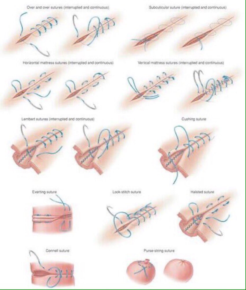 Kraygwerks's tweet photo. Breve guía de Suturas. Por: https://t.co/7ykOTmZxmJ
#TREPH #APH
#MedEd #FOAMems
#MedicinaTactica https://t.co/YPkxZgOIPa