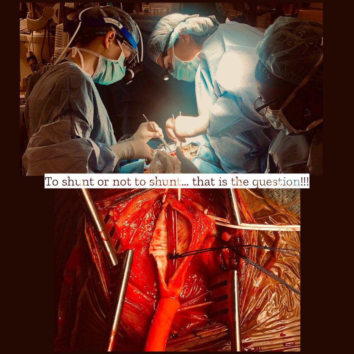 JHHVascular's tweet photo. Our faculty are a mixed bag when it comes to shunting during #CEA. What’s your preference? https://t.co/dc0OZEl1HM