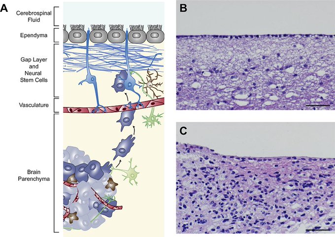 JHCnews's tweet image. From our December Special Issue on Cancer Stem Cell Niches: “Histological Studies of the Ventricular–Subventricular Zone as Neural Stem Cell and Glioma Stem Cell Niche” is free online: bit.ly/31CW6ql 

#StemCell #NeuralStemCell #Glioma
