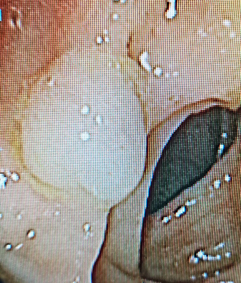 GIDrDon's tweet photo. Found this on a 26yo patient with chronic diarrhea, brbpr and no FH of CRC. Yeap likely not the cause of her symptoms but sure would have caused a whole lot of problems of we didn't take it out #colonpolyp #colorectalcancerawareness #colonoscopysaveslives #GITwitter #MedTwitter https://t.co/f0qe3QkCoR