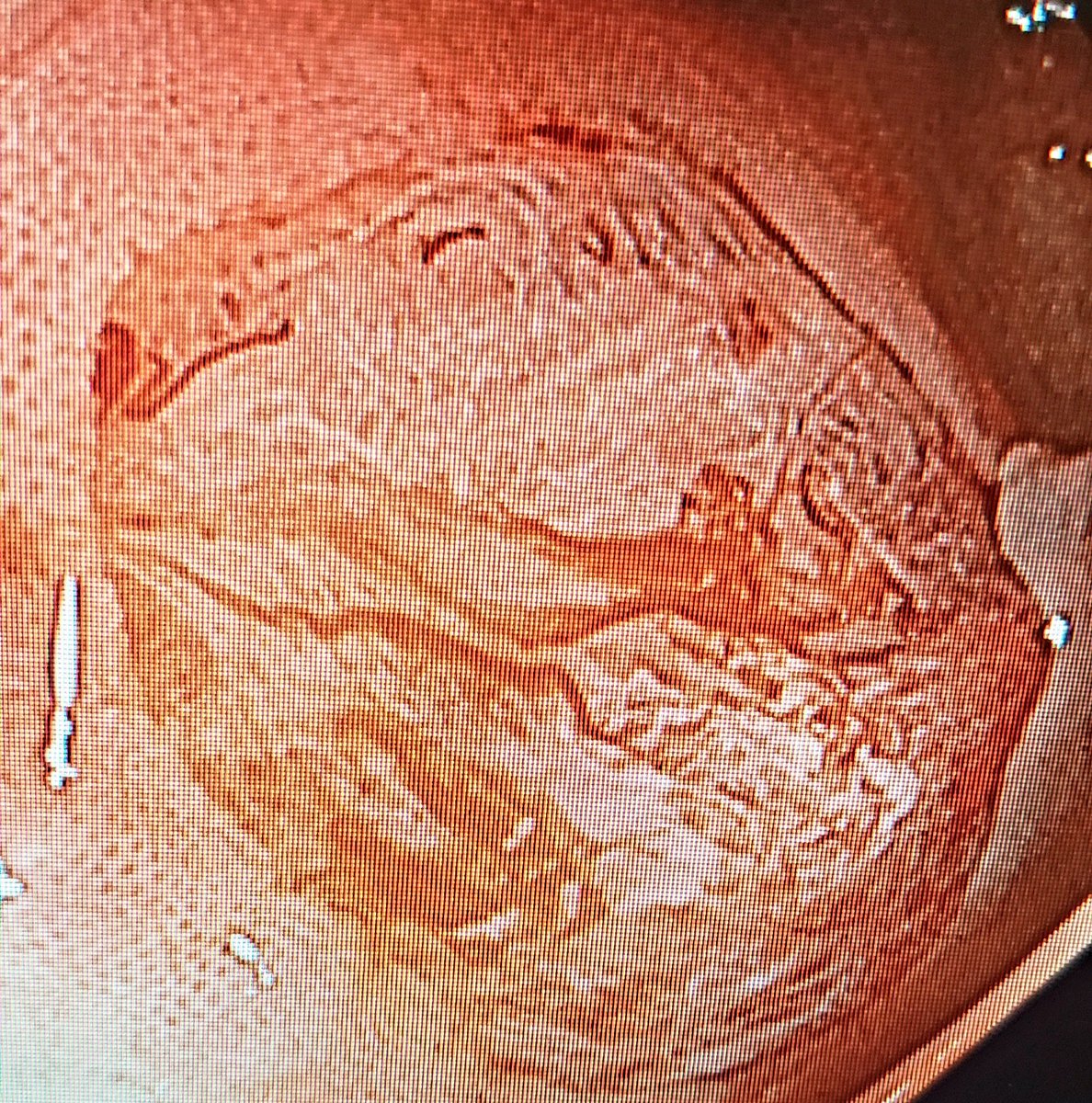 Found this on a 26yo patient with chronic diarrhea, brbpr and no FH of CRC. Yeap likely not the cause of her symptoms but sure would have caused a whole lot of problems of we didn't take it out #colonpolyp #colorectalcancerawareness #colonoscopysaveslives #GITwitter #MedTwitter