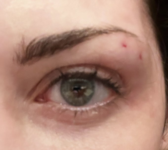 1 year update: just got it done again. A little swollen but you get the idea https://t.co/9sgqbfhFRY