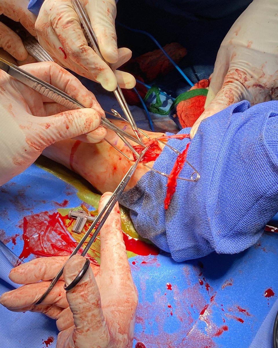 bswhvascular's tweet photo. Below knee popliteal to dorsalis pedis bypass #limbsalvage #vasclife https://t.co/hi378SpF0e