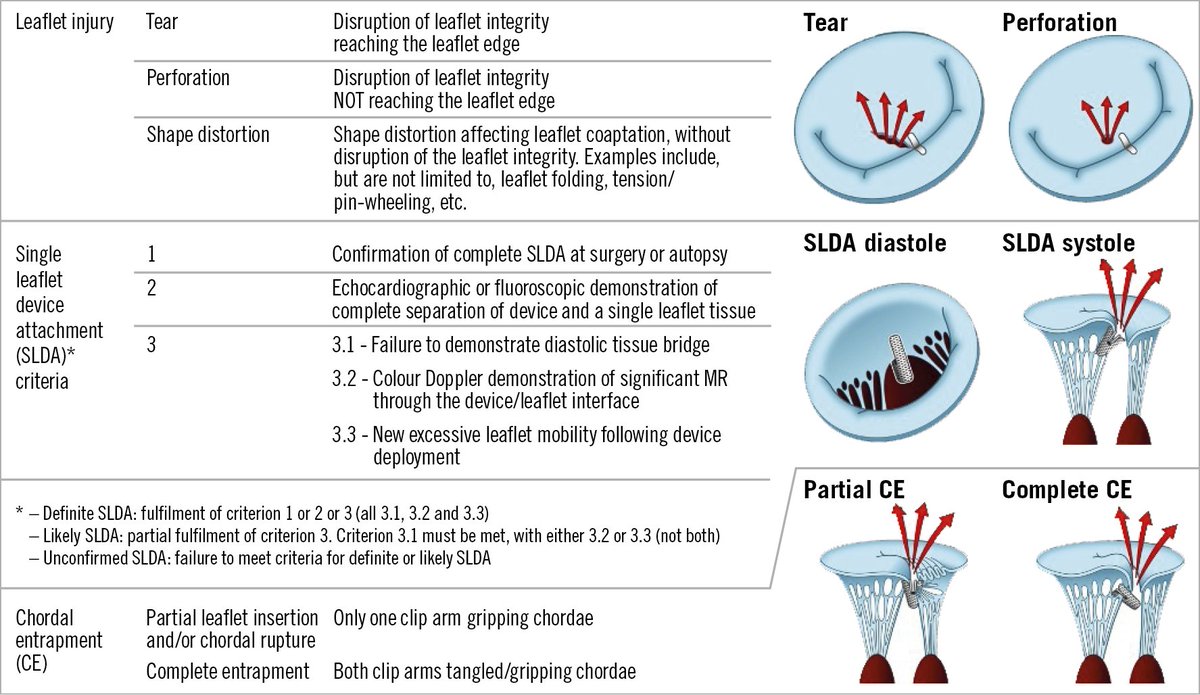In this article, the authors reported the incidence of leaflet adverse events after TEER with the Mitraclip system in the global EXPAND study, provided details on the different types of complications, and proposed practical standardized definitions.
eurointervention.pcronline.com/article/incide…