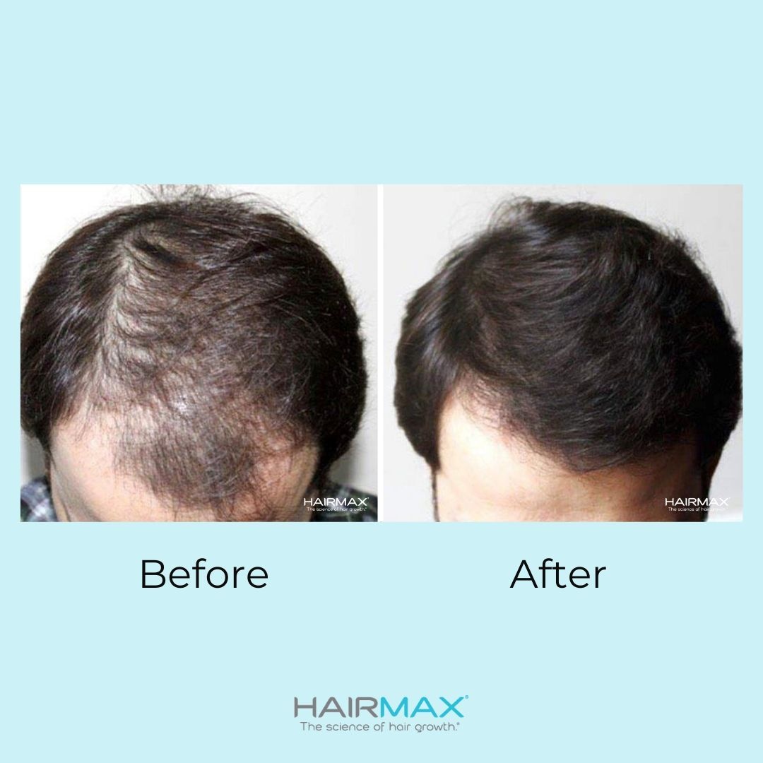 ヘアマックス Hairmax 日本版【公式】 (@HairmaxJ) / X