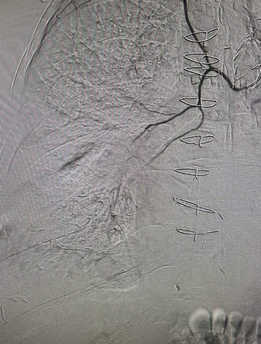 Massive hemoptysis in setting of PNA and anticoagulation. POSITIVE bleed seen from selective bronchial art run 🫁🩸👀. No more hemoptysis after bronchial art embo (BAE) w 300-500 micron particles. <a href="/dotter_IR/">The Dotter Institute</a> <a href="/Ryan_Schenning/">Ryan Schenning, MD</a> <a href="/SIR_ECS/">SIR ECS</a> <a href="/SIRRFS/">SIR RFS</a>