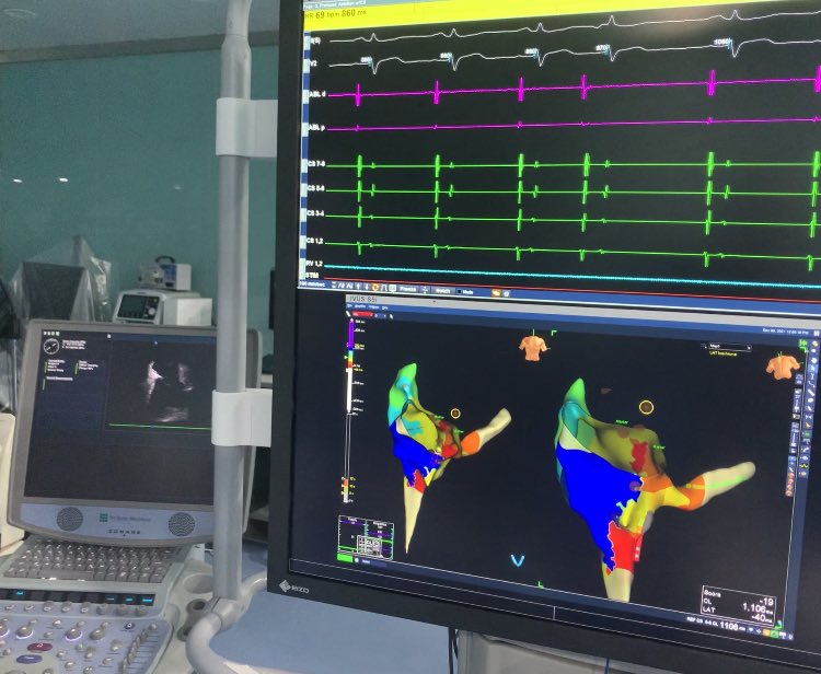 Dr. Ali Al Sayegh (@dr_alsayeq) on Twitter photo Inspired by the tweets of Dr Razminia <a href="/MRazminia/">Mansour Razminia</a> one of our early work with flourless/ICE guided CTI ablation <a href="/Mo_PedsEP/">Mohammad Ebrahim</a> Inspired by the tweets of Dr Razminia <a href="/MRazminia/">Mansour Razminia</a> one of our early work with flourless/ICE guided CTI ablation <a href="/Mo_PedsEP/">Mohammad Ebrahim</a>