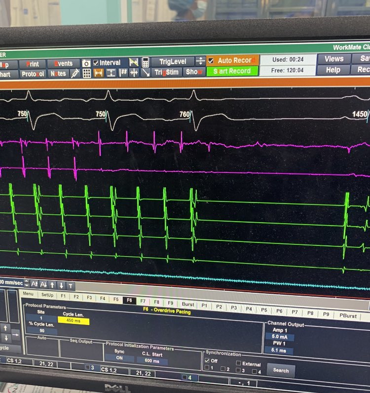dr_alsayeq's tweet photo. Inspired by the tweets of Dr Razminia @MRazminia one of our early work with flourless/ICE guided CTI ablation @Mo_PedsEP https://t.co/WtLKeCiIxG