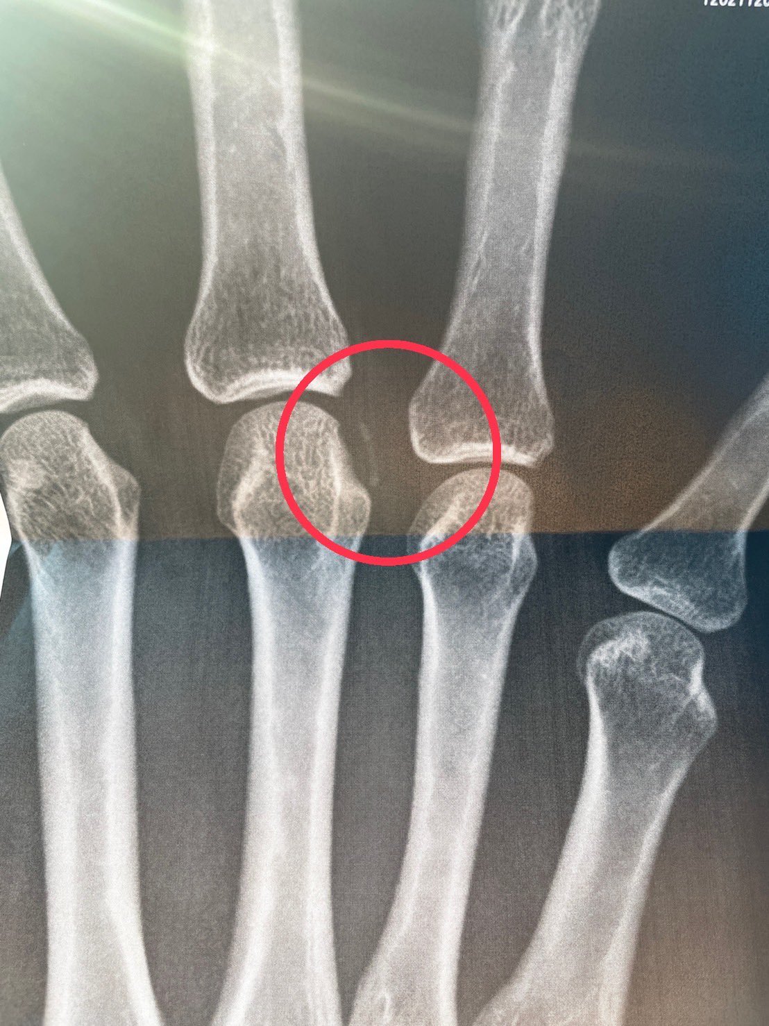 تويتر Ayukawa Mana على تويتر 私の今年一年 アキレス腱損傷 手首負傷 コロナ感染 指剥離骨折 イマココ 最後の最後もやってしまいました 今年全部アクシデントの怪我などでしたが 今回はもはや身に覚えがありません 流石にレントゲン見て瞬間に笑えてき