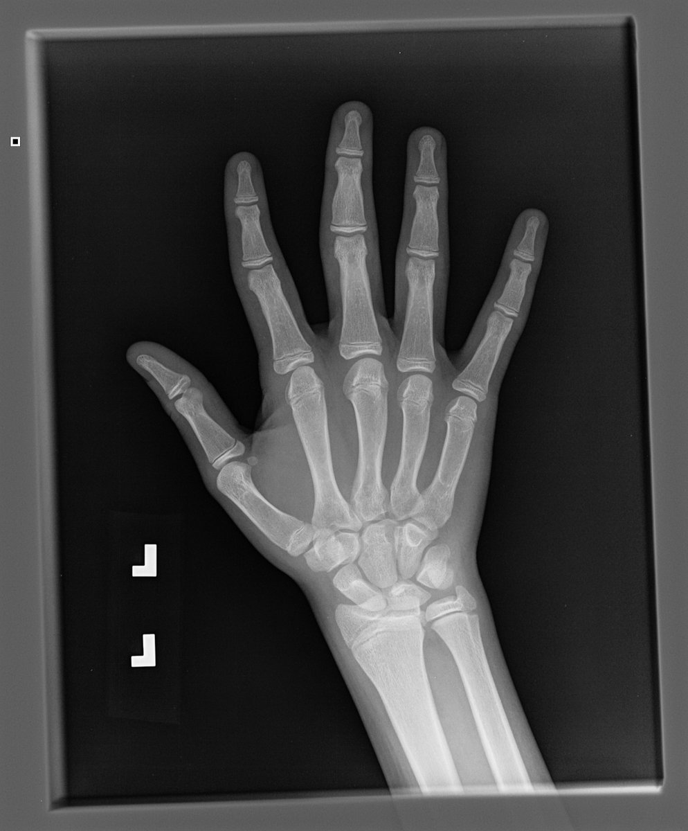 Rare #genetic disorders collectively affect more than 6% of the global population and skeletal dysplasia constitute an important group of such disorders. Due to their rarity, their accurate #diagnosis is a very challenging process ... (1/2)