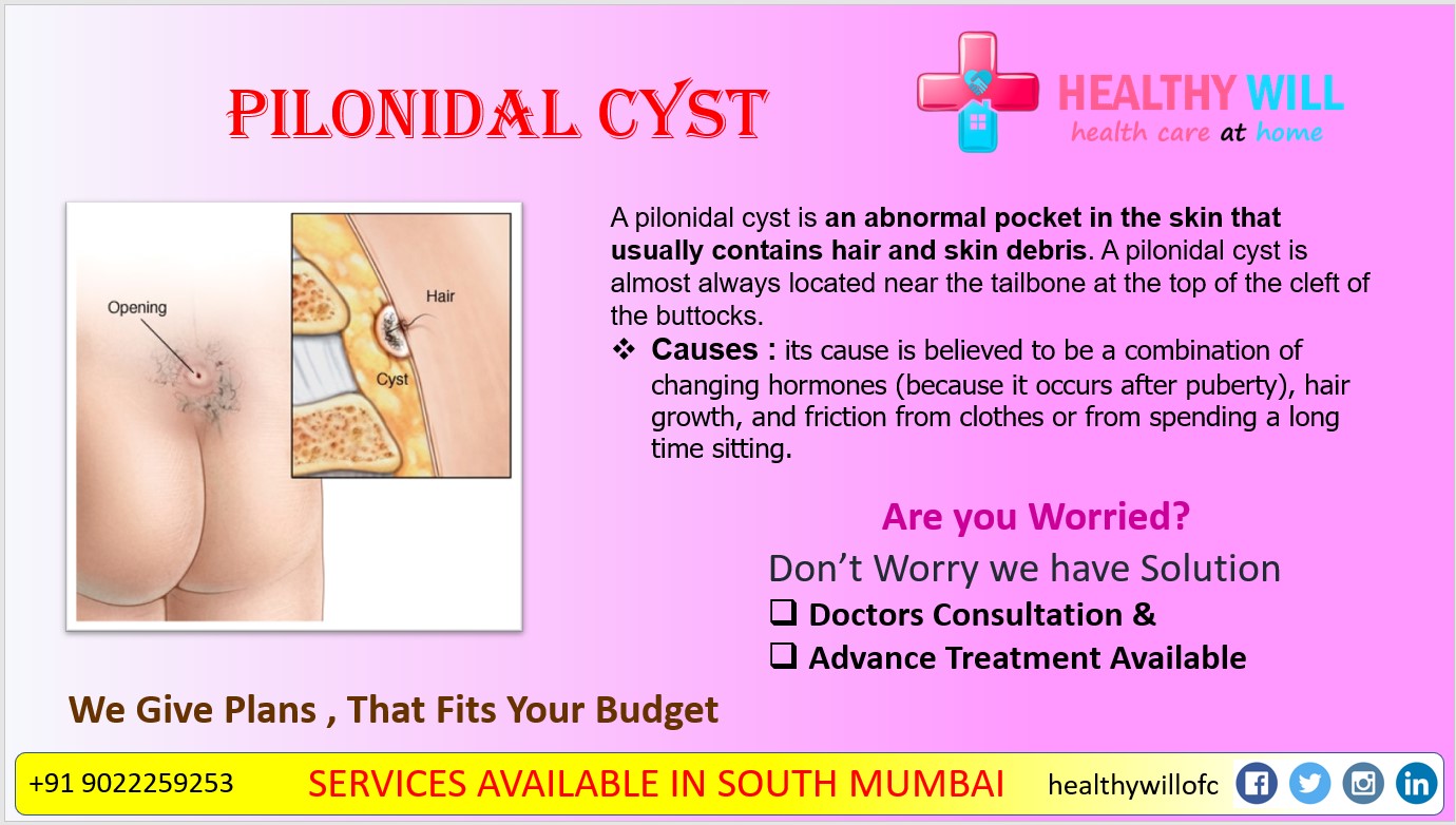 Pilonidal Cyst: What Is It, Causes, Treatment, and More