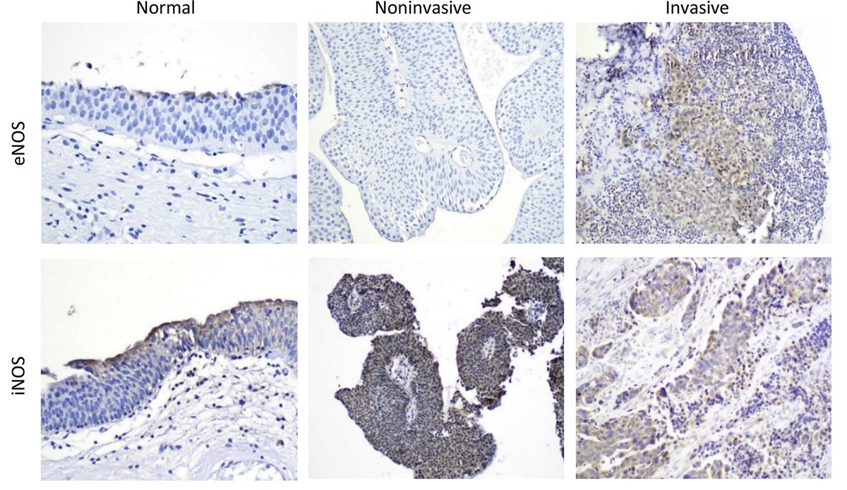 #BladderCancer Invasion is Mediated by Mammalian Target of Rapamycin Complex 2-Driven Regulation of Nitric Oxide and Invadopodia Formation. FREE Editor's Choice article from <a href="/ASIPath/">American Society for Investigative Pathology</a> member Donna Hansel and co-authors <a href="/UCSanDiego/">UC San Diego</a> and <a href="/OHSUNews/">OHSU News</a>). ajp.amjpathol.org/article/S0002-… #mTOR