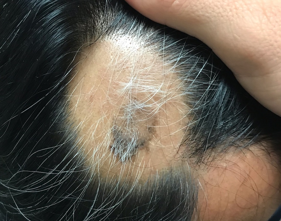 ClinRev's tweet photo. A man suddenly lost a section of hair, only to have it grow back gray. He’s upset about this phenomenon; can you provide reassurance? https://t.co/eviGHXcUE9 © 2021 Clinician Reviews/Frontline Medical Communications Inc https://t.co/uzrCBVVCeM