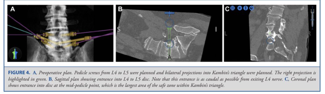 JohnHShinMD's tweet photo. Latest on 🤖 from @DukeSpine @abdelbarrspine now published @NeurosurgeryCNS #ONSFree: Robotic-Assisted Trajectory Into Kambin's Triangle During Percutaneous TLIF - Series Investigating Safety and Efficacy. Check it out! 

@CNS_Update @spinesection 

https://t.co/HeG1Psr4Gw https://t.co/7nXgP9IltL
